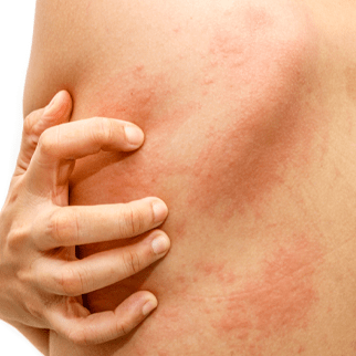 Intense Pulsed Light Therapy