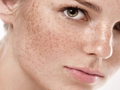 Melasma Treatment