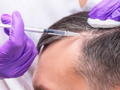 Hair Loss and Treatments
