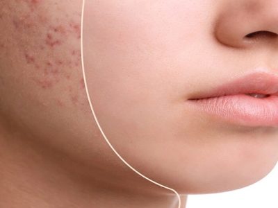 Isotretinoin Treatment