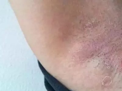 Hidradenitis Suppurativa