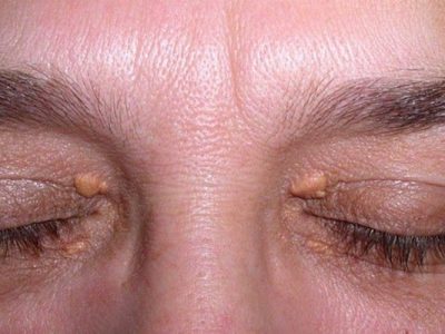 Xanthelasma