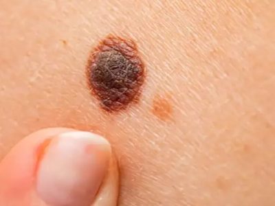 Skin cancers