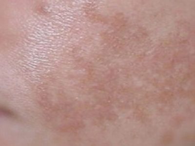 Melasma