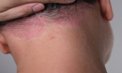 Seborrheic Dermatitis