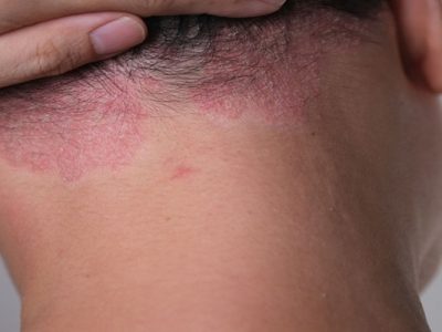 Seborrheic Dermatitis