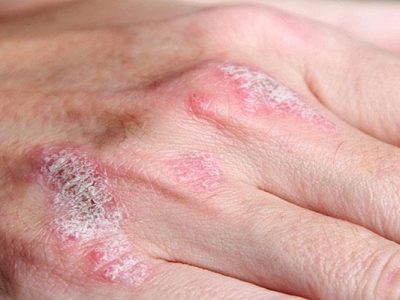 Psoriasis