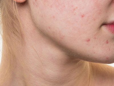 Fillers For Acne Scars