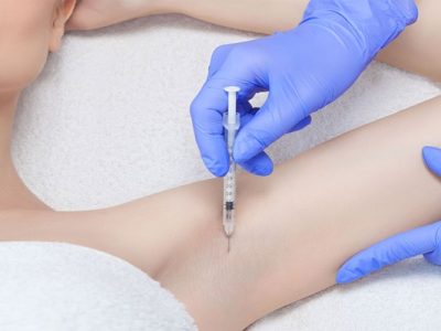 Hyperhidrosis Treatment with Botulinum Toxin