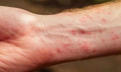 Scabies Disease