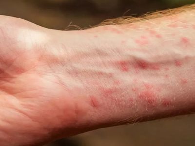 Scabies Disease